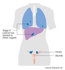 Most ovarian tumors are benign. Https Www Mater Ie Services Gynaecological Oncology Ovarian Cancer Information Pdf