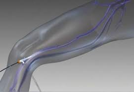 Image result for Radiofrequency Surgery