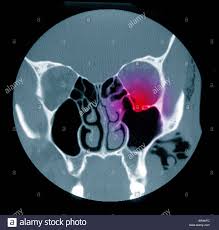 They allow us the ability to interact with our environment and lift out body up against gravity. Ct Scan Zeigt Eine Orbitale Blowout Fraktur Des Gesichts Ct Scan Orbital Blowout Fraktur Stockfotografie Alamy
