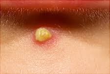 Image result for Pustule
