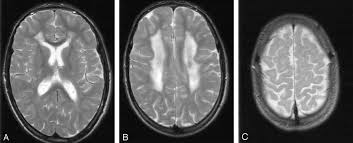 Mr Imaging And Proton Mr Spectroscopic Studies In Sjogren Larsson Syndrome Characterization Of The Leukoencephalopathy American Journal Of Neuroradiology