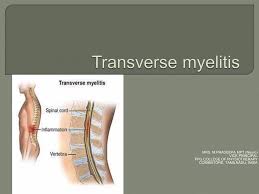 Image result for Myelitis
