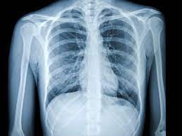 When a lung tumor causes tightness in the chest or presses on nerves, you. Chest X Ray For The Diagnosis Of Lung Cancer