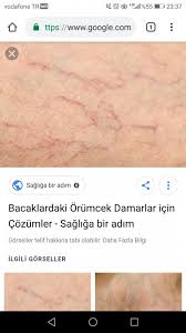 Kilcal Damar Catlamasi Hamilelikte Anne Sagligi