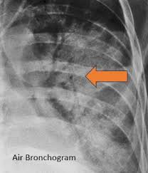 Image result for Air Bronchogram