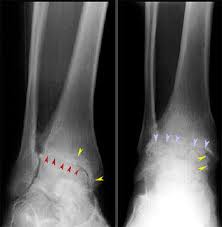 Image result for Talar Tilt