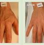 treatment for bulging hand veins from veintreatmentcenter.com