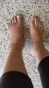 Its lower end forms the lateral malleolus, the outer bump of the ankle. How Long Does A Rolled Ankle Need To Heal Quora