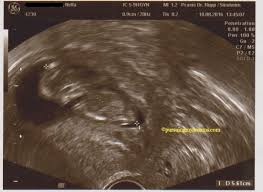 Jika bo maka rahim akan teraba kosong. Cerita Trimester Pertama Hamil Anak Kedua Pursuing My Dreams