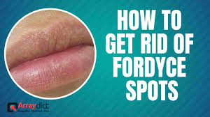 How to get rid of fordyce spots with turmeric? 3 Best Ways To Get Rid Of Fordyce Spots On Lips