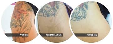 Numbing the skin before, during, and after tattoo removal if you have low pain tolerance, it's better to perform pain relief procedures before, during, and after the laser tattoo removal treatments. Before And After Pictures Tattoolos
