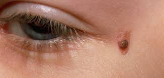 أصنع طريقا شبه جزيرة بورجون الثالول داخل العين comertinsaat com