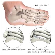 Image result for Metatarsal