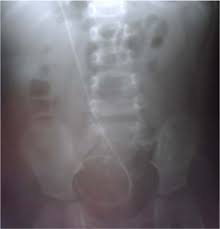 X Rays Of The Urinary Tract Showing Vp Shunt Distal Segment In The Download Scientific Diagram