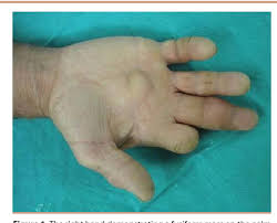 We did not find results for: A Rheumatoid Nodule Of The Hand An Important And Rare Differential Diagnosis Of Swellings Of The Hand Case Report And Literature Review Semantic Scholar