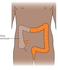 Signs and symptoms of colon cancer include: Surgery For Colon Cancer Macmillan Cancer Support