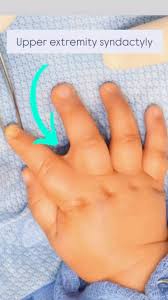 Image result for Syndactyly