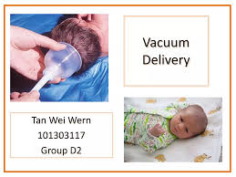 Image result for Vacuum Caput