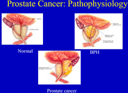 Symptoms of cancer in men include: Swg Renal Final Exam Large Group 7 Urology Sl P900 Flashcards Quizlet