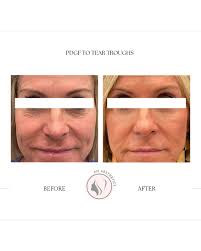 Our email list saw it first 👀 It's peel season, baby! 😍 THIS MONTH ONLY —  We are offering 50% OFF a 4% Retinol Peel with plant exosomes when you add  it