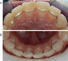 Orthodontic Bonded Retainers A Narrative Review Dental Update