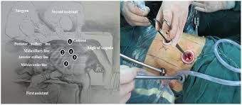 Mie is surgery to remove cancer in the esophagus. Plos One Modified Mckeown Minimally Invasive Esophagectomy For Esophageal Cancer A 5 Year Retrospective Study Of 142 Patients In A Single Institution