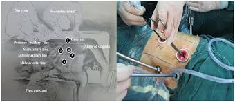 Read patient reviews and find contact information. Plos One Modified Mckeown Minimally Invasive Esophagectomy For Esophageal Cancer A 5 Year Retrospective Study Of 142 Patients In A Single Institution