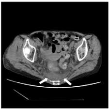 We did not find results for: Abnormal Density Area In The Presacral Region Of Patients With Fever Of Unknown Origin
