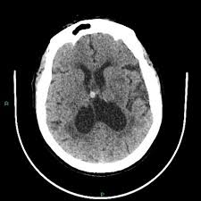 Small Vessel Disease Radiology Case Radiopaedia Org
