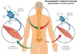 Amyotrophic lateral sclerosis (als), also known as lou gehrig's disease or motor neuron disease, is a progressive neurological disease that causes the neurons that control voluntary muscles (motor neurons) to degenerate, according to the national institutes of health (nih). Als A Closer Look At Stem Cells