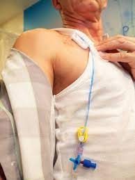 A catheter connects the port to a large vein, most often in your chest. Answers To All Your Questions On Chemoports Onco Com