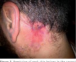 Image result for phlegmon on face)