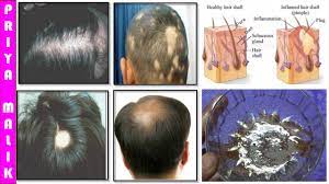 Acv is considered by many to be a miracle treatment for numerous medical and dermatological problems. Grow Long Hair 100 Natural Hair Loss Treatment Cure Baldness Remove Dandruff Thin Hair Hair Fall Youtube