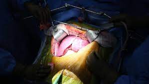 By ricky harminder bhogal, stephanos. Liver Resection Surgery Indications Types Cost Procedures Causes Complications