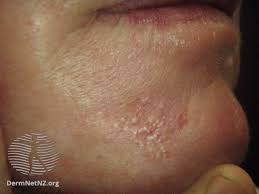 Un núcleo sólido puede verse a menudo en el medio de la pequeña protuberancia. Comedonal Acne Symptoms Causes Treatment Prevention