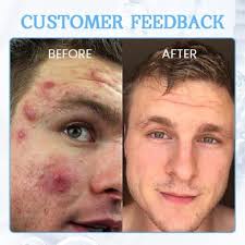 Tiworld™ PoreClear 2% Omi isọdọtun awọ ara BHA