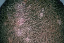In most cases, people will tolerate the chemicals in the hair dye, however, if your skin if more sensitive, a reaction why is my scalp weeping clear fluid? 7 Common Scalp Issues How To Treat Rashes Bumps Scabs And Pimples On Scalp