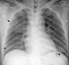 Pneumonia is a bacterial, viral, or fungal infection of the lungs that causes the air sacs, or alveoli, of the lungs to fill up with fluid or pus. Radiographic And Ct Features Of Viral Pneumonia Radiographics