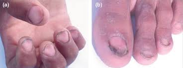 Image result for Koilonychia feet