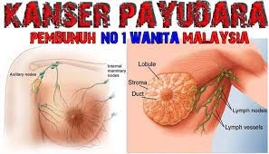 Bahkan di tahap ini kanker kemungkinan telah menyebar hingga ke 9 kelenjar getah bening di ketiak atau dekat tulang dada. Kanser Payudara Jom Ambil Tahu Pengedar Shaklee Sg Buloh 012 3814786