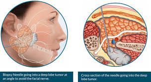 Image result for Paropsia