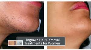 Some of you reading this blog may have seen entries in the past talking about my experience with laser hair removal. Laser Hair Removal Miami Before After Results Youtube