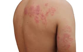 Image result for shingles