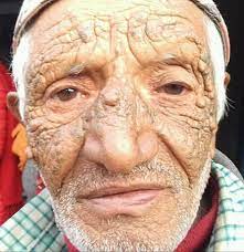 A blackhead is also called an open comedo (single for comedone), and it is a clogged pore in the skin that is open to the air. Category Favre Racouchot Syndrome Wikimedia Commons