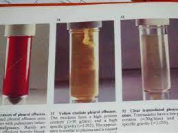 Mesothelioma of the pleura is the only known malignant disease of the pleura, almost in all cases of mesothelioma is caused by exposure to asbestos. Pleural Diseases