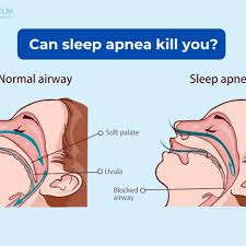 Image result for Sleep Apnea