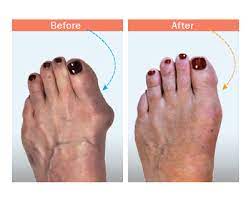 Bunion Surgery New York City - Podiatrist Dr. Meisler