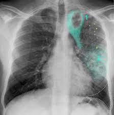 Find out about having the scan, what happens and and how you might feel afterwards. Lung Cancer Amboss
