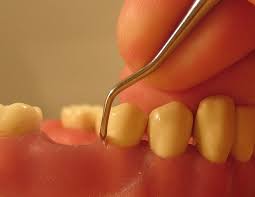 Krasse et al. // swed. Gingivitis Symptoms