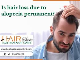 It can be the result of heredity, hormonal changes, medical conditions or a normal part of aging. Is Hair Loss Due To Alopecia Permanent Cyber Hairsure